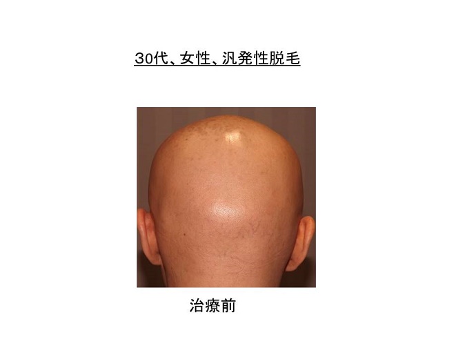 円形脱毛症　病院""